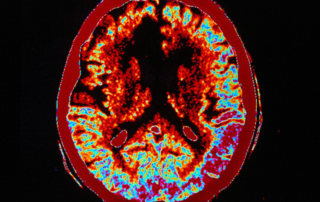 Стволови клетки при лечение на инсулт